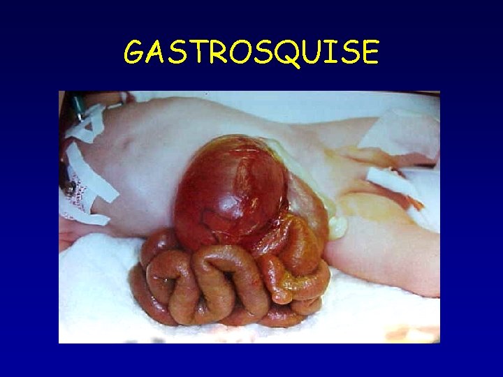 GASTROSQUISE GASTROSQUISE