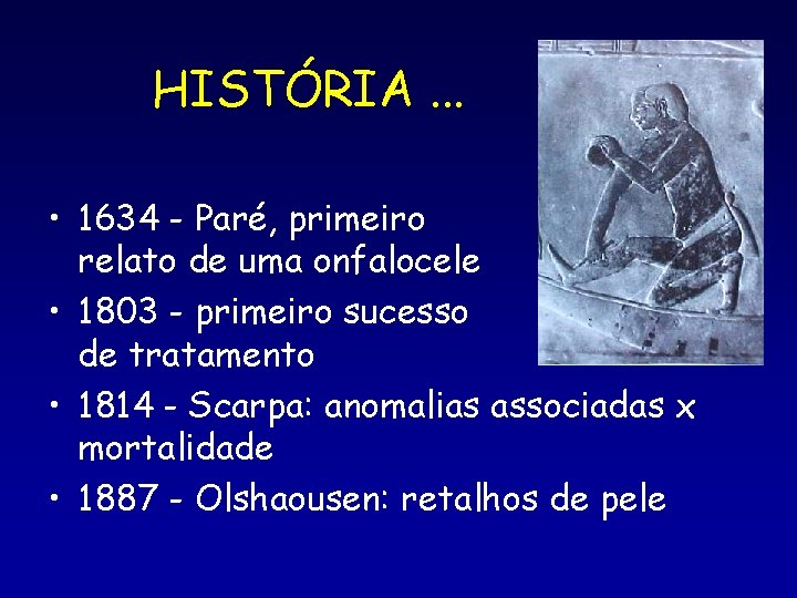 HISTÓRIA. . . • 1634 - Paré, primeiro relato de uma onfalocele • 1803