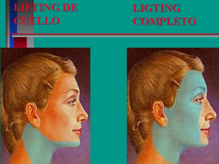 LIFTING DE CUELLO LIGTING COMPLETO 