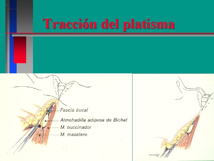 Tracción del platisma 