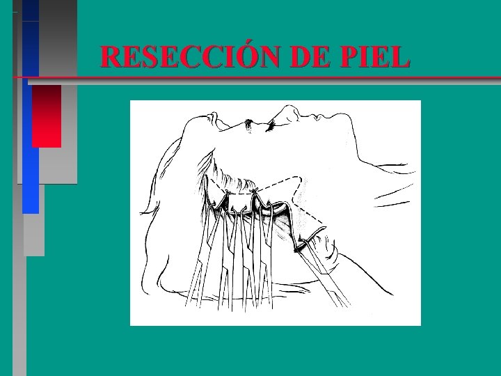 RESECCIÓN DE PIEL 