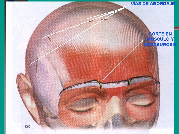 VÍAS DE ABORDAJE CORTE EN MUSCULO Y APONEUROSIS 