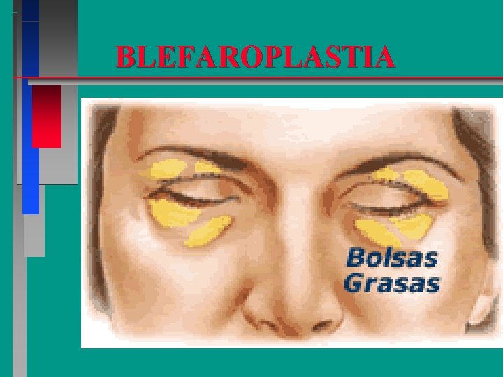 BLEFAROPLASTIA 