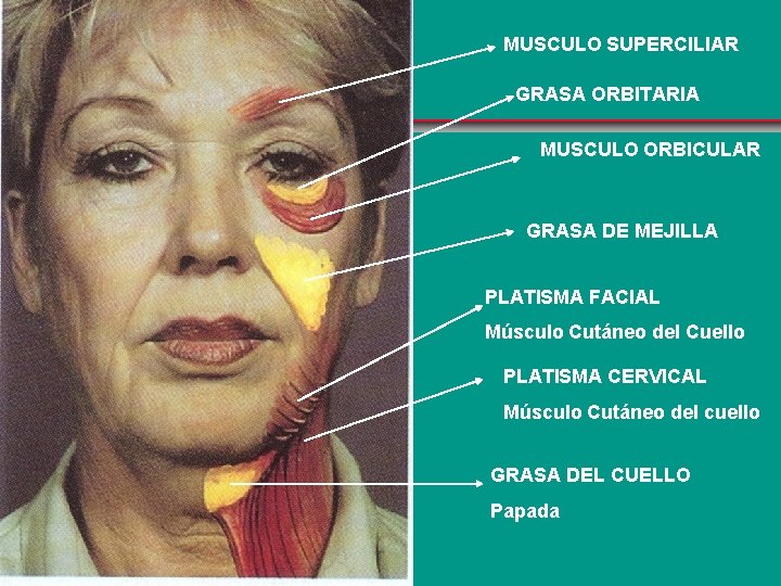 MUSCULO SUPERCILIAR GRASA ORBITARIA MUSCULO ORBICULAR GRASA DE MEJILLA PLATISMA FACIAL Músculo Cutáneo del