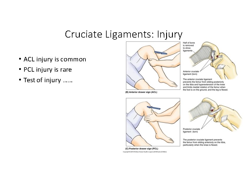 Cruciate Ligaments: Injury • ACL injury is common • PCL injury is rare • Cruciate Ligaments: Injury • ACL injury is common • PCL injury is rare •