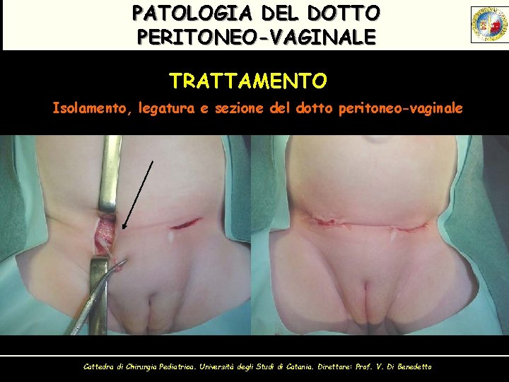 PATOLOGIA DEL DOTTO PERITONEO-VAGINALE TRATTAMENTO Isolamento, legatura e sezione del dotto peritoneo-vaginale Cattedra di