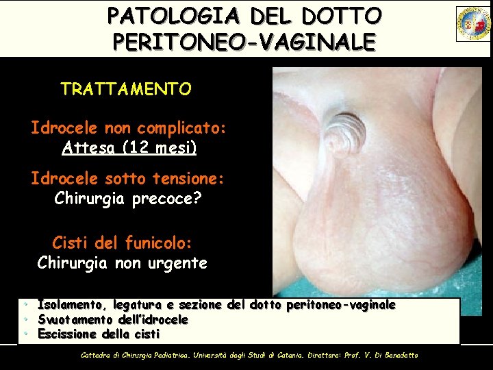 PATOLOGIA DEL DOTTO PERITONEO-VAGINALE TRATTAMENTO Idrocele non complicato: Attesa (12 mesi) Idrocele sotto tensione: