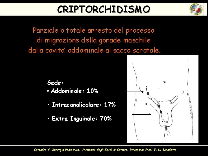 CRIPTORCHIDISMO Parziale o totale arresto del processo di migrazione della gonade maschile dalla cavita’