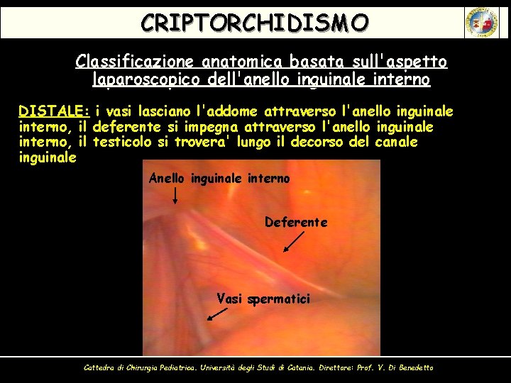 CRIPTORCHIDISMO Classificazione anatomica basata sull'aspetto laparoscopico dell'anello inguinale interno DISTALE: i vasi lasciano l'addome