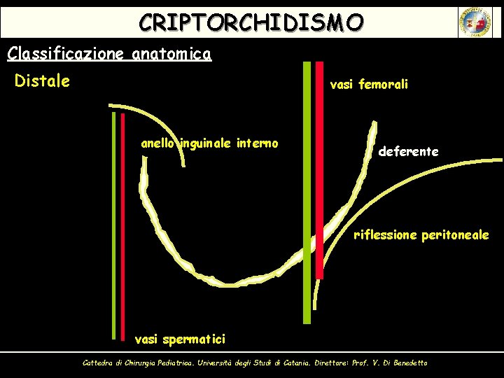 CRIPTORCHIDISMO Classificazione anatomica Distale vasi femorali anello inguinale interno deferente riflessione peritoneale vasi spermatici