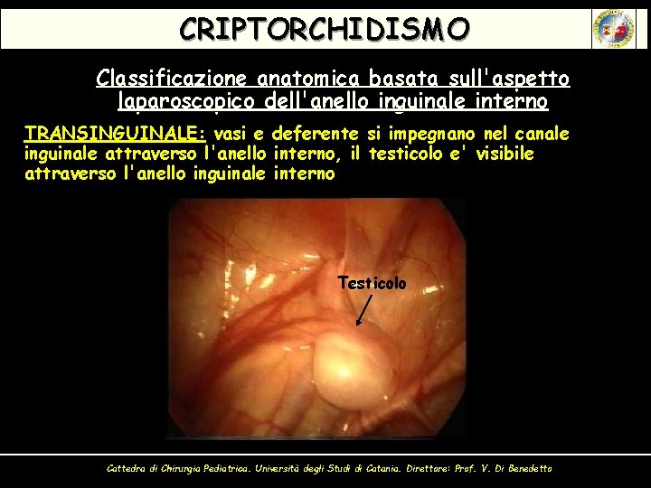 CRIPTORCHIDISMO Classificazione anatomica basata sull'aspetto laparoscopico dell'anello inguinale interno TRANSINGUINALE: vasi e deferente si