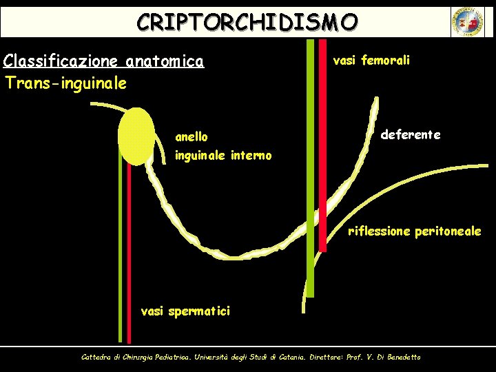 CRIPTORCHIDISMO Classificazione anatomica Trans-inguinale anello inguinale interno vasi femorali deferente riflessione peritoneale vasi spermatici