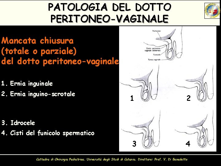 PATOLOGIA DEL DOTTO PERITONEO-VAGINALE Mancata chiusura (totale o parziale) del dotto peritoneo-vaginale 1. Ernia