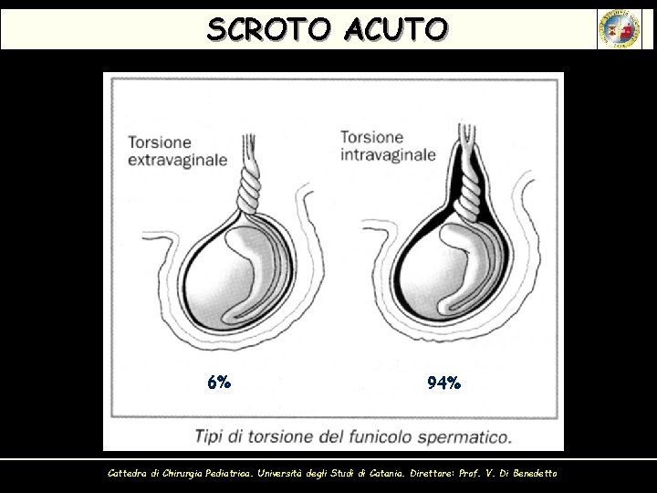 SCROTO ACUTO 6% 94% Cattedra di Chirurgia Pediatrica. Università degli Studi di Catania. Direttore: