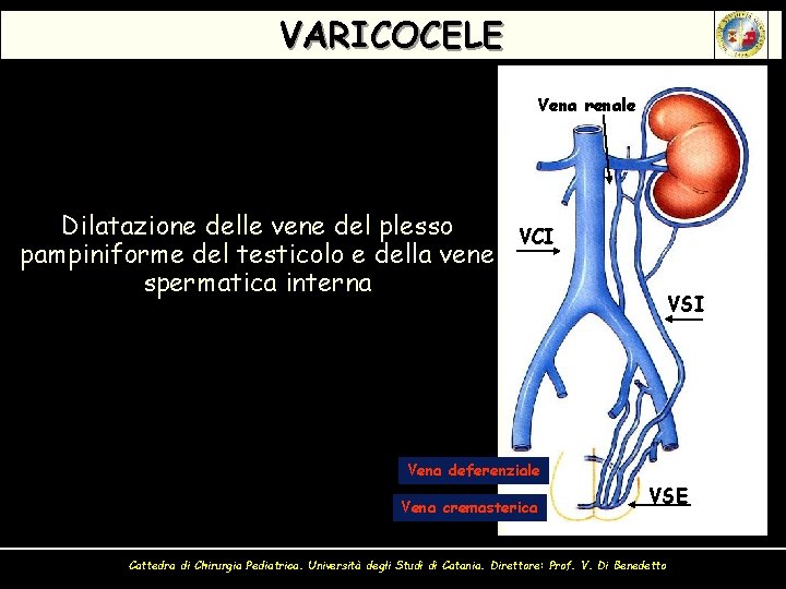 VARICOCELE Vena renale Dilatazione delle vene del plesso pampiniforme del testicolo e della vene