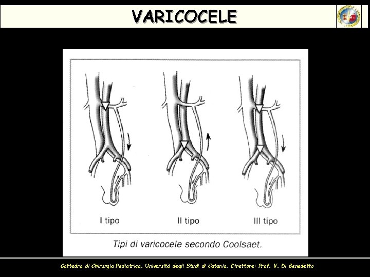 VARICOCELE Cattedra di Chirurgia Pediatrica. Università degli Studi di Catania. Direttore: Prof. V. Di