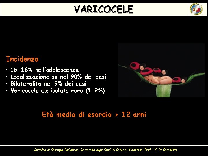 VARICOCELE Incidenza • • 16 -18% nell’adolescenza Localizzazione sn nel 90% dei casi Bilateralità