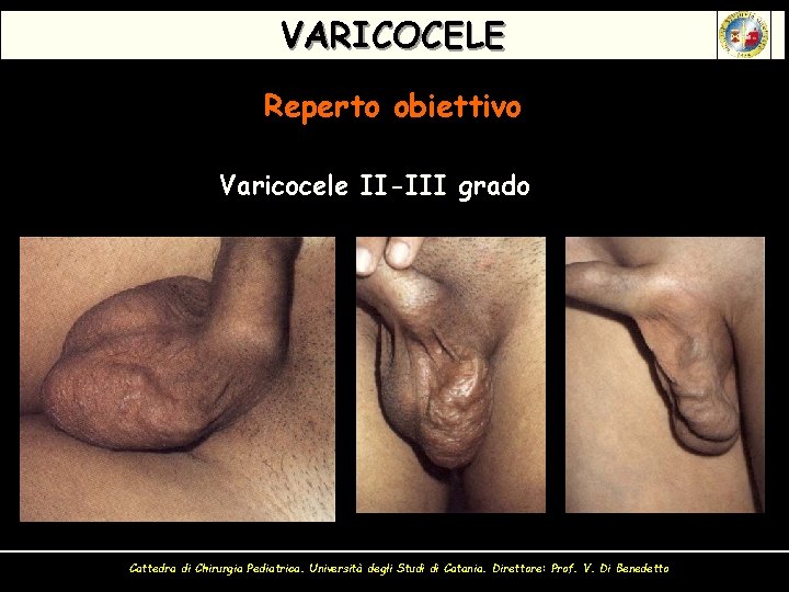 VARICOCELE Reperto obiettivo Varicocele II-III grado Cattedra di Chirurgia Pediatrica. Università degli Studi di