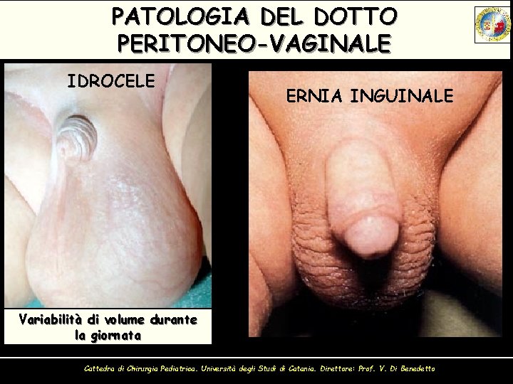 PATOLOGIA DEL DOTTO PERITONEO-VAGINALE IDROCELE ERNIA INGUINALE Clinica Tumefazione, spesso intermittente, lungo il decorso