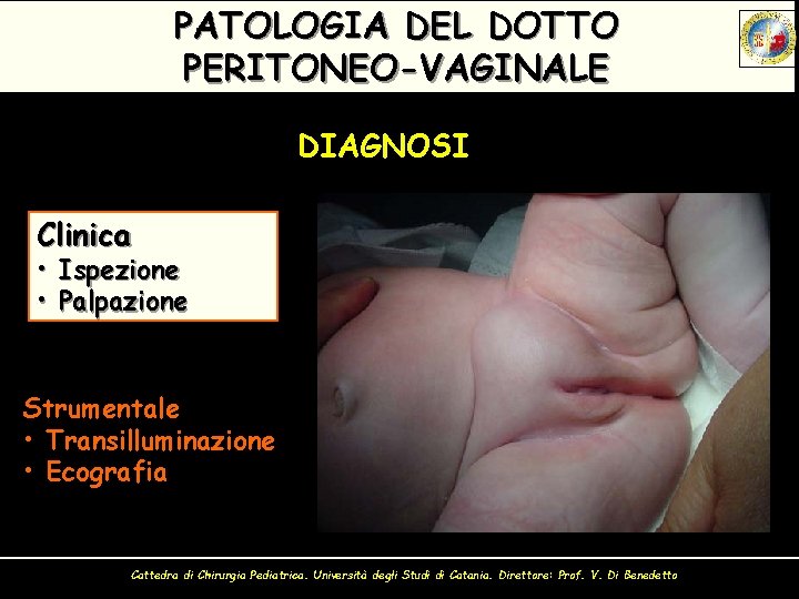 PATOLOGIA DEL DOTTO PERITONEO-VAGINALE DIAGNOSI Clinica • Ispezione • Palpazione Strumentale • Transilluminazione •