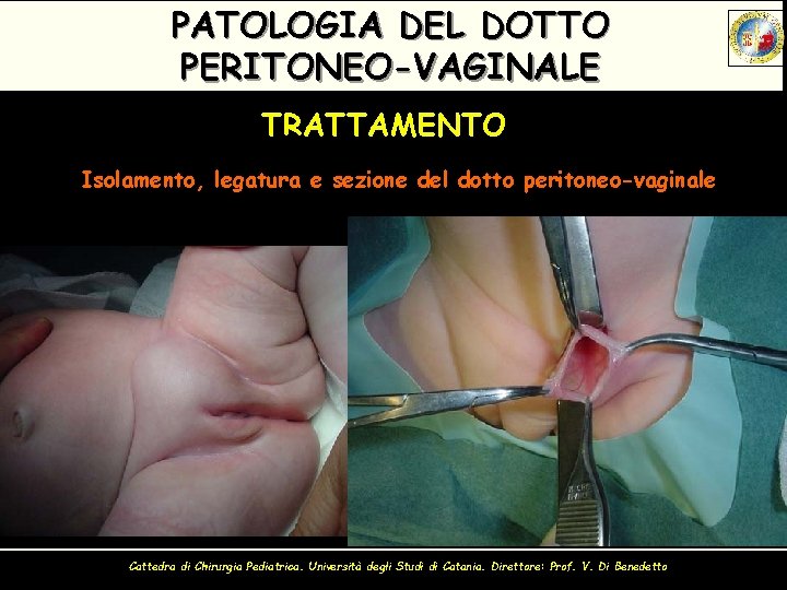 PATOLOGIA DEL DOTTO PERITONEO-VAGINALE TRATTAMENTO Isolamento, legatura e sezione del dotto peritoneo-vaginale Cattedra di