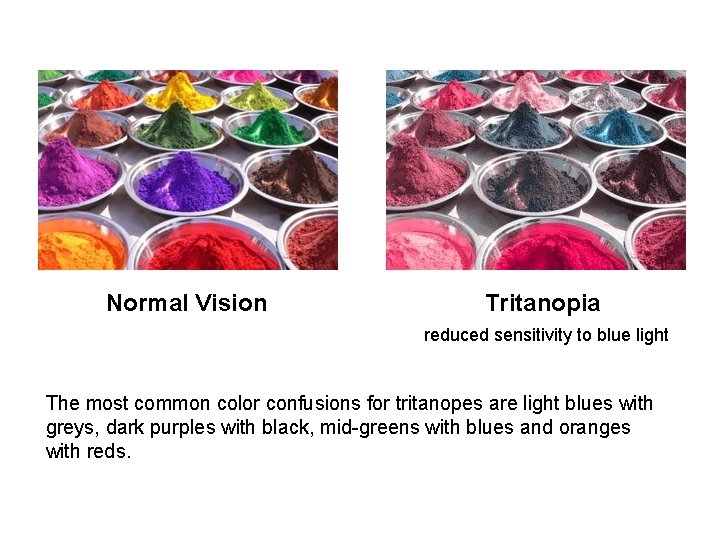 Normal Vision Tritanopia reduced sensitivity to blue light The most common color confusions for