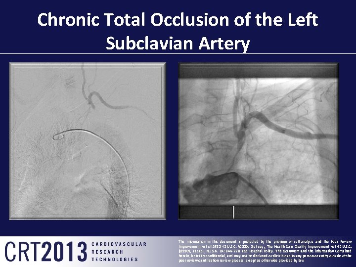Chronic Total Occlusion of the Left Subclavian Artery The information in this document is