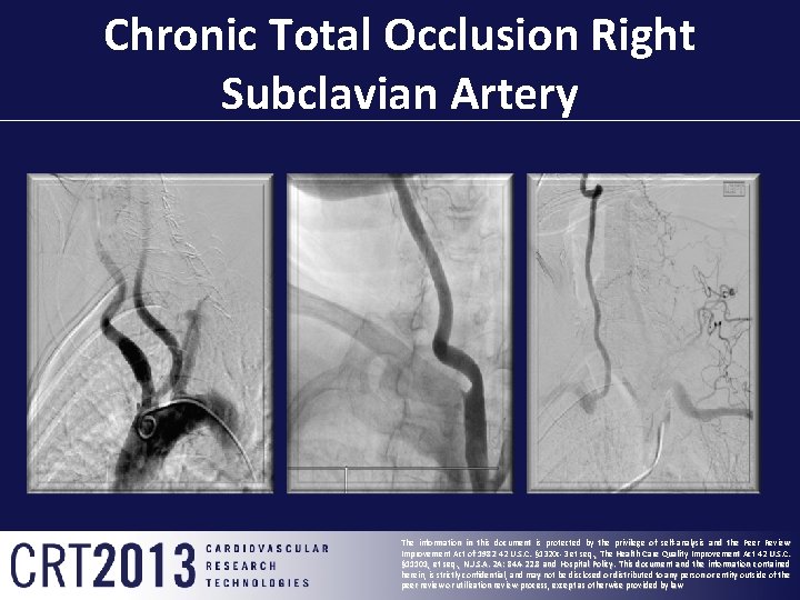 Chronic Total Occlusion Right Subclavian Artery The information in this document is protected by