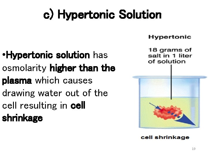 c) Hypertonic Solution • Hypertonic solution has osmolarity higher than the plasma which causes