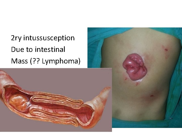 2 ry intussusception Due to intestinal Mass (? ? Lymphoma) 