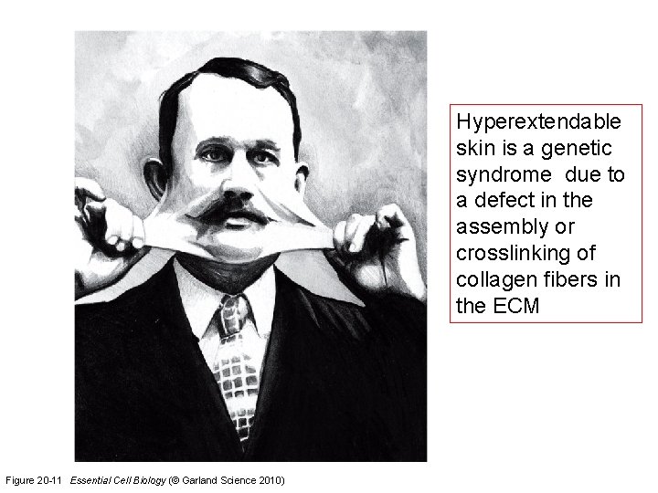 Hyperextendable skin is a genetic syndrome due to a defect in the assembly or