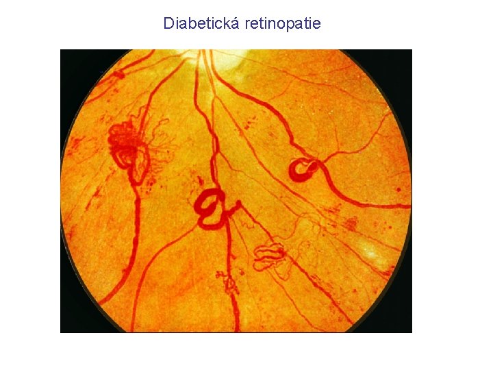 Diabetická retinopatie 