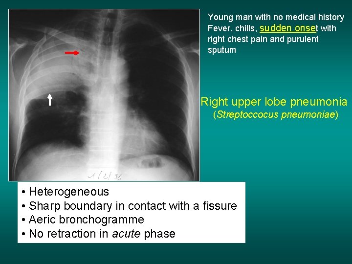 Young man with no medical history Fever, chills, sudden onset with right chest pain