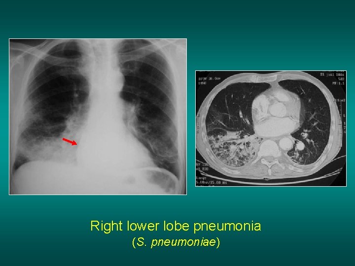 Right lower lobe pneumonia (S. pneumoniae) 