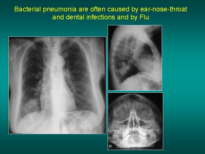 Bacterial pneumonia are often caused by ear-nose-throat and dental infections and by Flu 