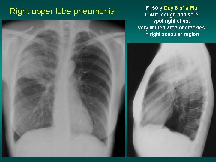 Right upper lobe pneumonia F. 50 y Day 6 of a Flu t° 40°,