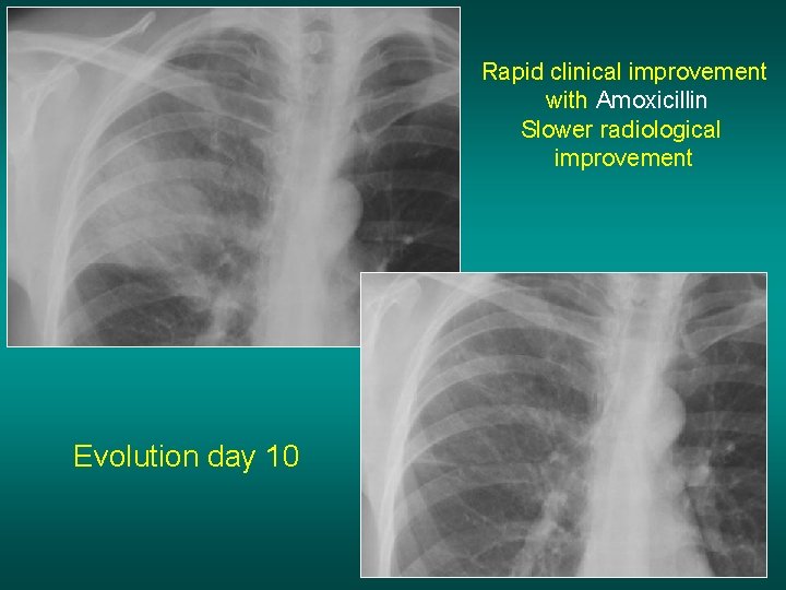Rapid clinical improvement with Amoxicillin Slower radiological improvement Evolution day 10 