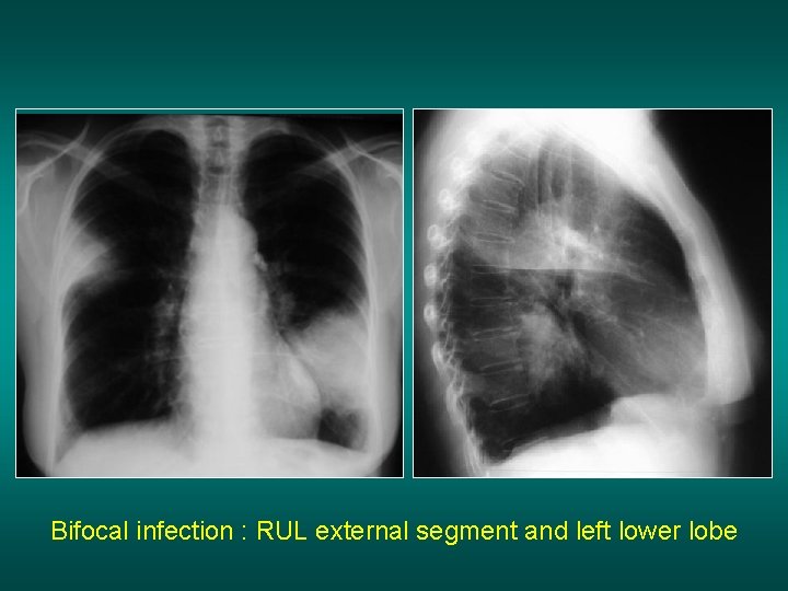 Bifocal infection : RUL external segment and left lower lobe 