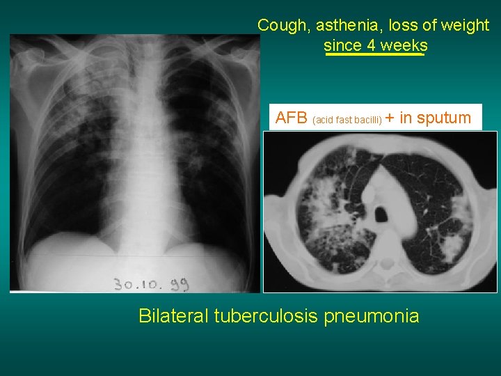 Cough, asthenia, loss of weight since 4 weeks AFB (acid fast bacilli) + in
