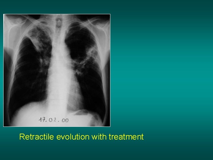 Retractile evolution with treatment 