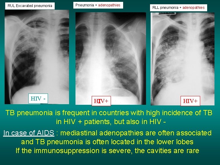 RUL Excavated pneumonia HIV - Pneumonia + adenopathies HIV+ RLL pneumonia + adenopathies HIV+