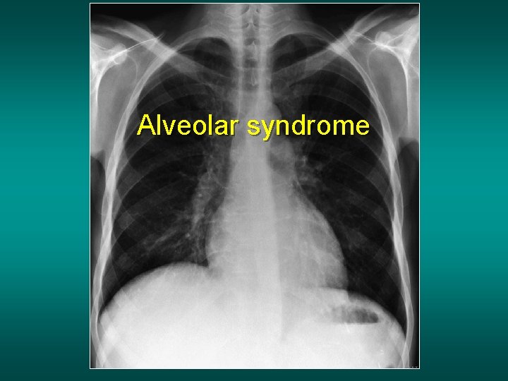 Alveolar syndrome 