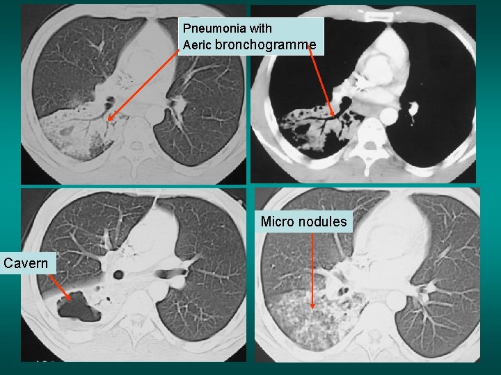 Pneumonia with Aeric bronchogramme Micro nodules Cavern 