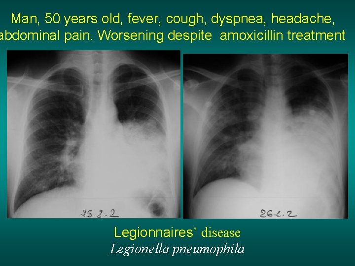 Man, 50 years old, fever, cough, dyspnea, headache, abdominal pain. Worsening despite amoxicillin treatment
