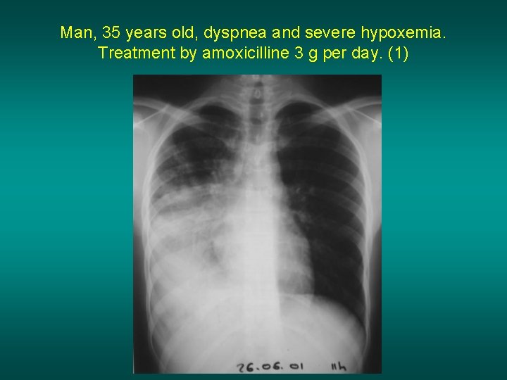 Man, 35 years old, dyspnea and severe hypoxemia. Treatment by amoxicilline 3 g per