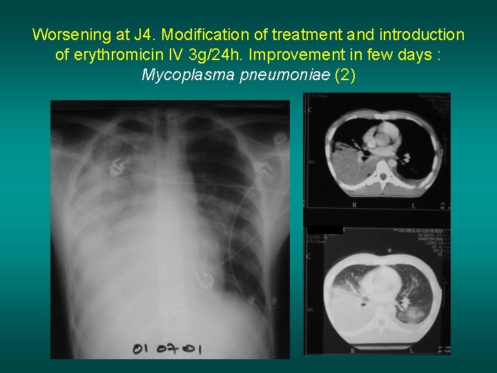 Worsening at J 4. Modification of treatment and introduction of erythromicin IV 3 g/24