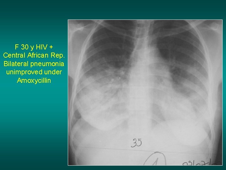 F 30 y HIV + Central African Rep. Bilateral pneumonia unimproved under Amoxycillin 