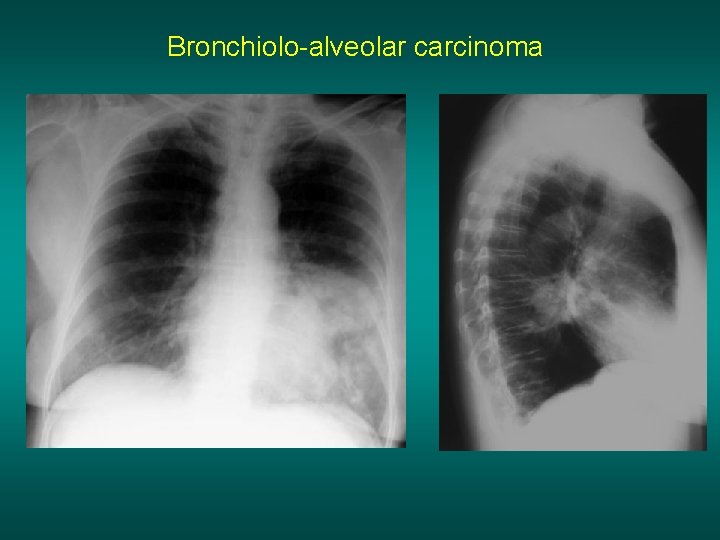 Bronchiolo-alveolar carcinoma 
