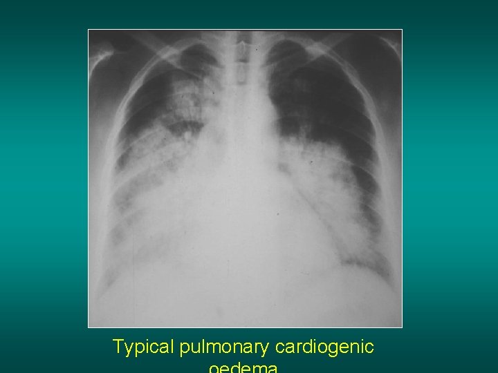 Typical pulmonary cardiogenic 