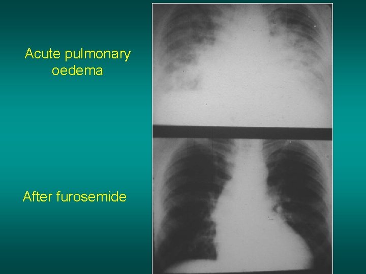 Acute pulmonary oedema After furosemide 